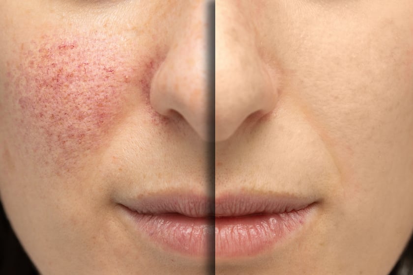 Bei rosacea heilerde 10 Natürliche